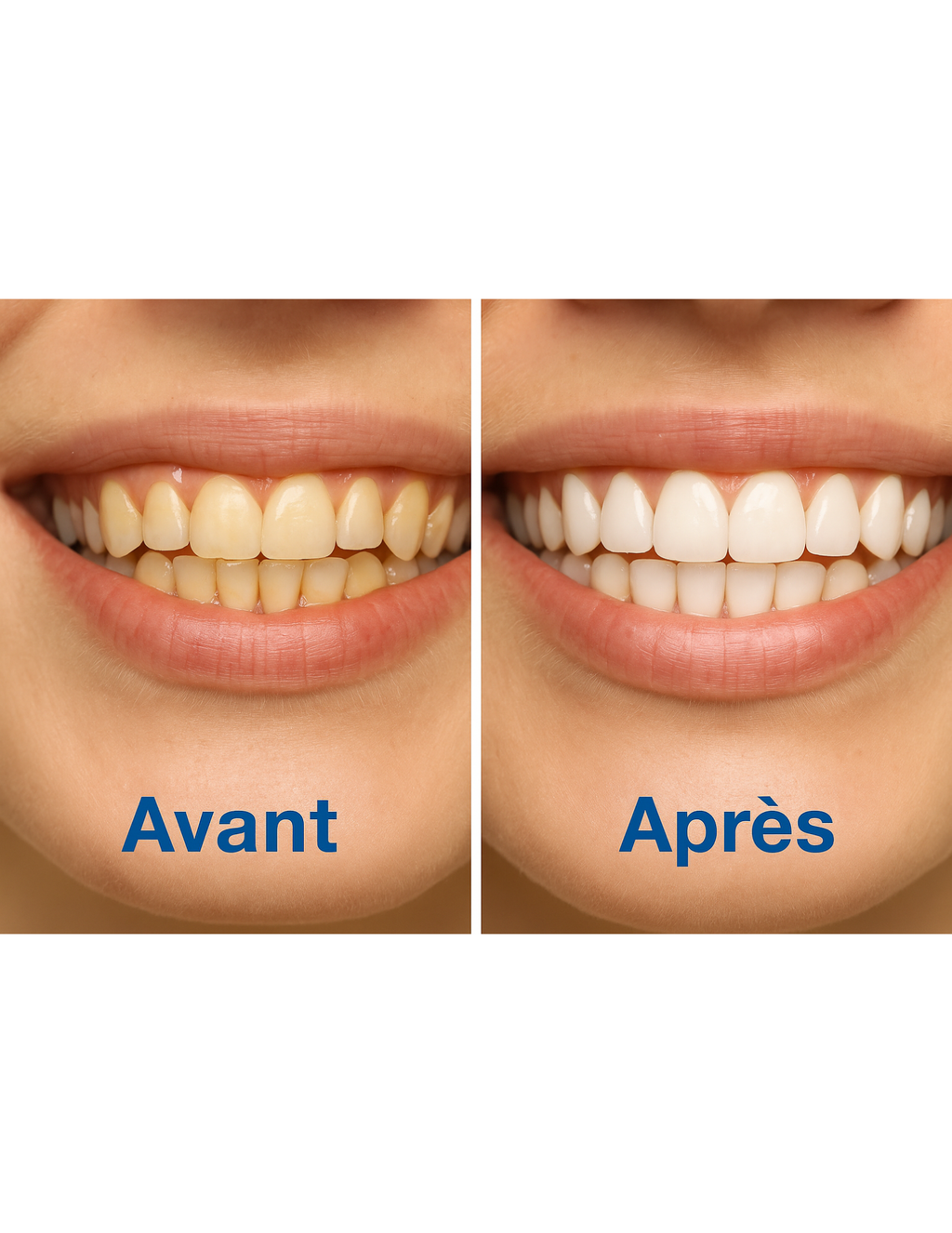 bandes blanchiment dentaire