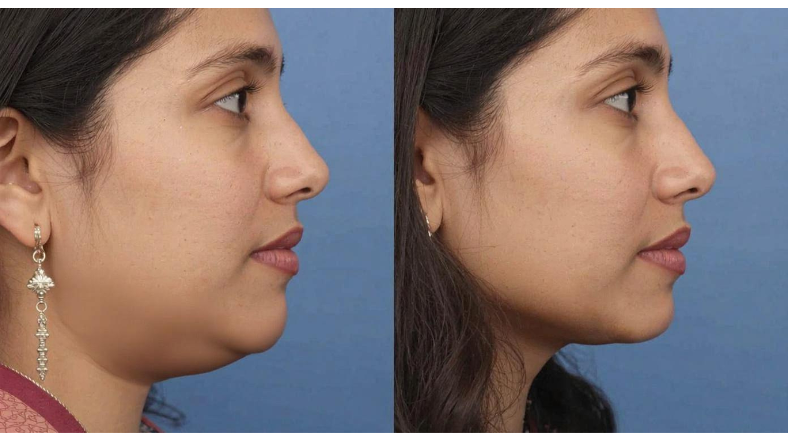 masque jawline